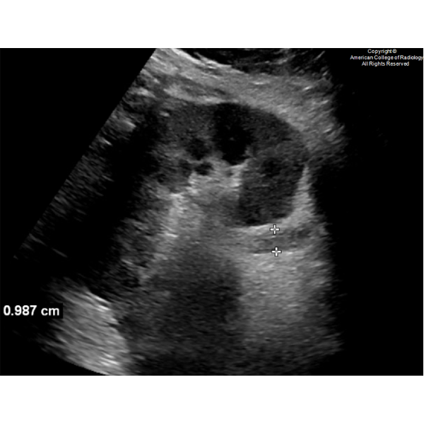 RadiologyACR's tweet photo. A 57-year-old male presents with right lower quadrant abdominal pain radiating to the right flank and poor oral intake. #ACRCaseinPoint https://t.co/2qm9tT92K3 https://t.co/TDPjkX1FT5