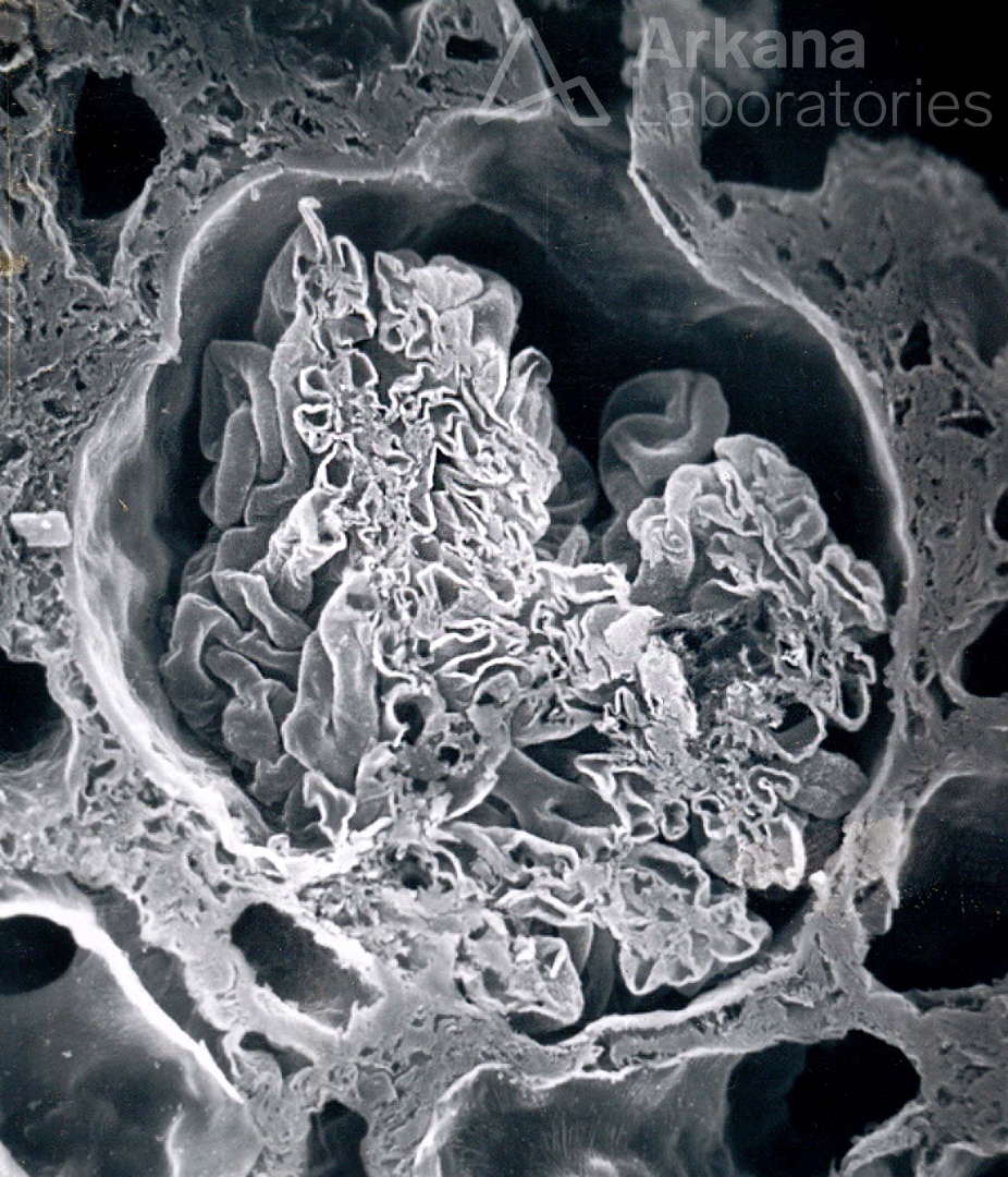 arkanalabs's tweet photo. Here is today’s #eyeSCANdy! Acellular scanning EM showing a glomerulus in cross-section though the macular densa and showing the origin of the proximal tubule from Bowman’s capsule.
Photo courtesy of Dr. Stephen Bonsib. #renal #pathology #kidneypath https://t.co/MIa6tbfWzZ