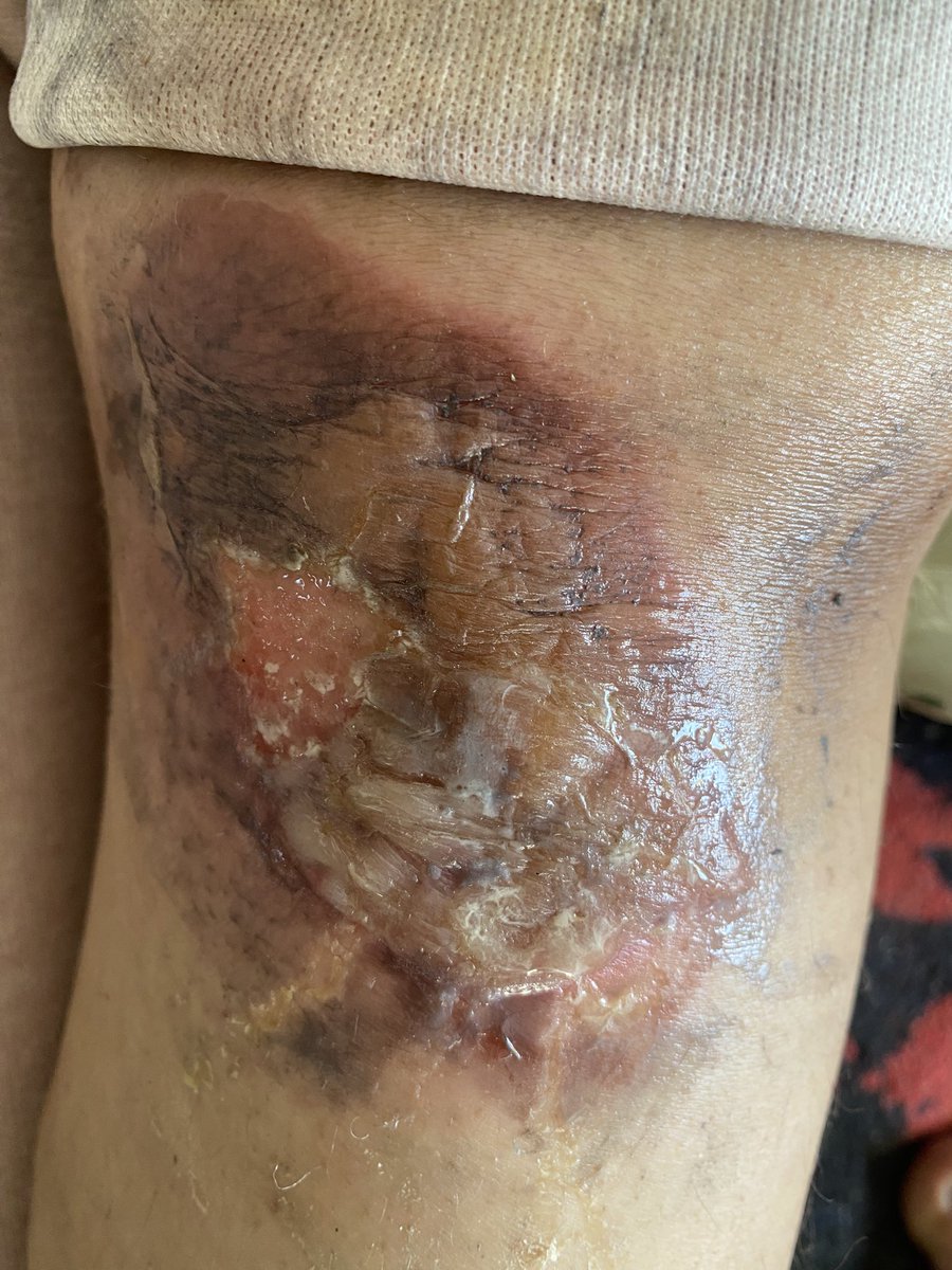 Mahmoud1723232's tweet photo. Hot oil spilled on my daughter Ghazal's hand ا🫂
 My child's joy was extinguished on the first day of Eid. I am extremely sad 😭
https://t.co/BNIEo1LeXY https://t.co/wcGd1YmHLq
