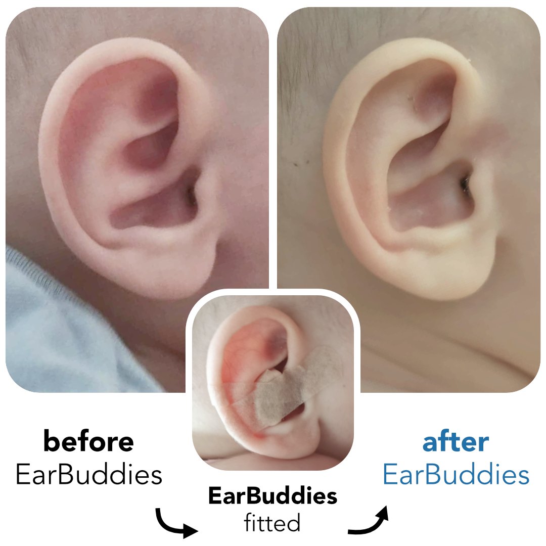 EarBuddies's tweet photo. "I'm so glad I didn't listen to everyone who told me to just leave it and that it would probably correct itself."

Read Diana's @EarBuddies story here: https://t.co/ZMLok9KZlP

#EarCorrection #EarBuddies #ears #motherhood #parenting #conchalcrus #earcondition #orejasdesoplillo https://t.co/sPmEFh6iU1