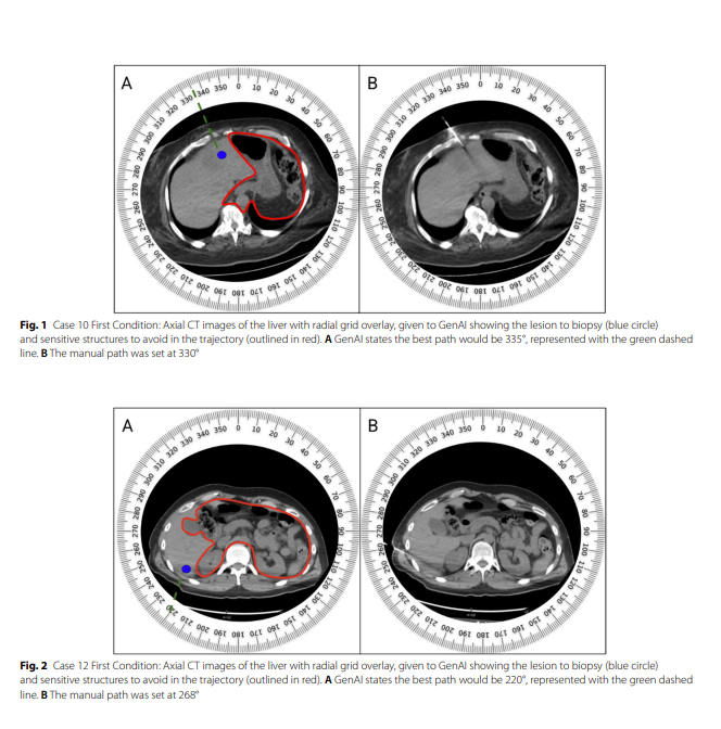 cvironco's tweet photo. Make sure to read this newly published research! 👇

Feasibility of generative #AI for CT-guided liver biopsy trajectory planning: a pilot study
https://t.co/bL8RnAuqvx https://t.co/0NgJ4lBsq3