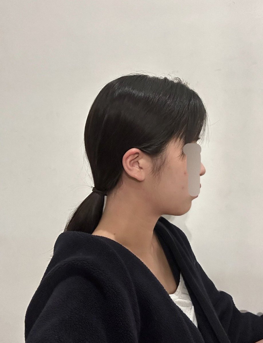 nonpomrin's tweet photo. DU美容外科 顎下＆フェイスライン脂肪吸引 3ヶ月後レポ https://t.co/JcPNsdmCTk