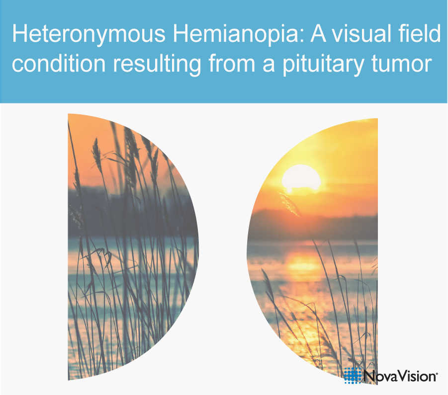 vycormedical's tweet photo. Heteronymous Hemianopia is a medical condition causing the loss of half of the visual field on different sides in both eyes. It is typically caused by a tumor on your pituitary gland exerting pressure on the Chiasma Opticum, the area above the gland where both optic nerves converge to send signals to the brain. This is a major highway for all visual stimuli, so anything that affects it will have major implications for the visual field, despite the relatively small size of the pituitary gland.

A new article from NovaVision, the vision rehabilitation division of Vycor Medical, explains how a pituitary tumor can cause major disorders like Heteronymous Hemianopia. The article goes into detail on what the disorder may look like to those that are afflicted by it and how it can affect a patient’s daily life. Several images are included to better highlight how vision is affected by this condition.

The article also gives some examples of different types of Heteronymous Hemianopia, as there are variants that affect different visual fields. While debilitating for those affected, the article concludes by saying that these symptoms typically subside after successful tumor treatment. However, if vision loss symptoms remain even after treating the tumor, NovaVision’s Vision Restoration Therapy could be the tool needed to bring that vision back to the levels they should be.

Read the full article here: https://t.co/2SVS9p7pfN

Learn more about NovaVision’s therapies at https://t.co/7JoXmBurwO or contact us at https://t.co/aqPiSzxRF5