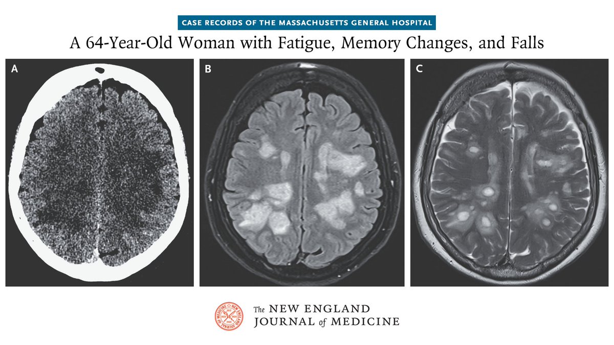 NEJM's tweet photo. Case Record of the Massachusetts General Hospital (@MassGeneralNews): A 64-year-old woman was admitted to the hospital because of fatigue, memory changes, and falls. 

The patient had been in her usual state of health until 3 weeks before the current presentation, when fatigue developed during a summer vacation in Maine. She had spent time outdoors near a lake but had had no known tick bites. 

One week before the current presentation, the patient had increasing fatigue while driving. She parked the car and called her husband, who took her to the emergency department of another hospital for evaluation. 

Read the full case details in “A 64-Year-Old Woman with Fatigue, Memory Changes, and Falls,” a Case Record of the Massachusetts General Hospital, by S. Bhattacharyya et al., from @BrighamWomens, @harvardmed, and Massachusetts General Hospital (@MassGeneralNews): https://t.co/G4XHecv0nM