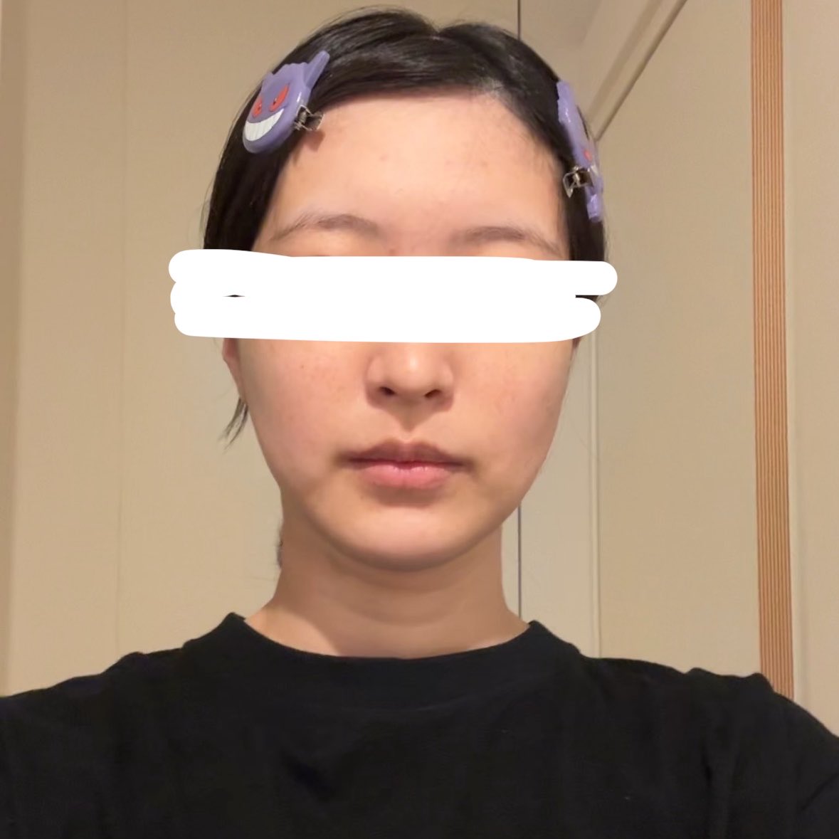 momo_gkhn's tweet photo. プレ除去+オトガイ形成
術後1週間！
だいぶ腫れ引いてきた！
けど下唇はあんまり感覚なくてうまく笑えない🙃 https://t.co/KXRYVh3mS9