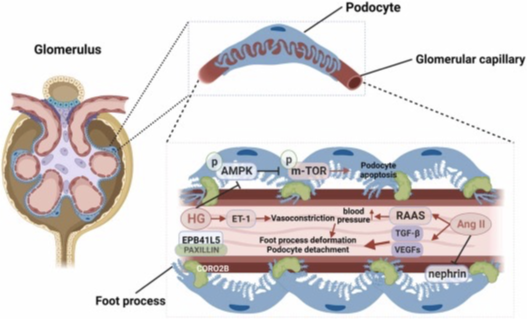 dakidneydoc's tweet photo. Multiple Mechanisms of podocyte injury at play in diabetes:

1. Lipotoxicity
2. Vascular Injury,Inflammation
3. Reactive Oxygen Species mediated injury
4. Mitochondrial toxicity

https://t.co/xL0oFt0R7W

#ECNeph @ISNkidneycare @Dilushiwijay @myadla @edgarvlermamd @DrGeetikaSingh1 @ECNeph