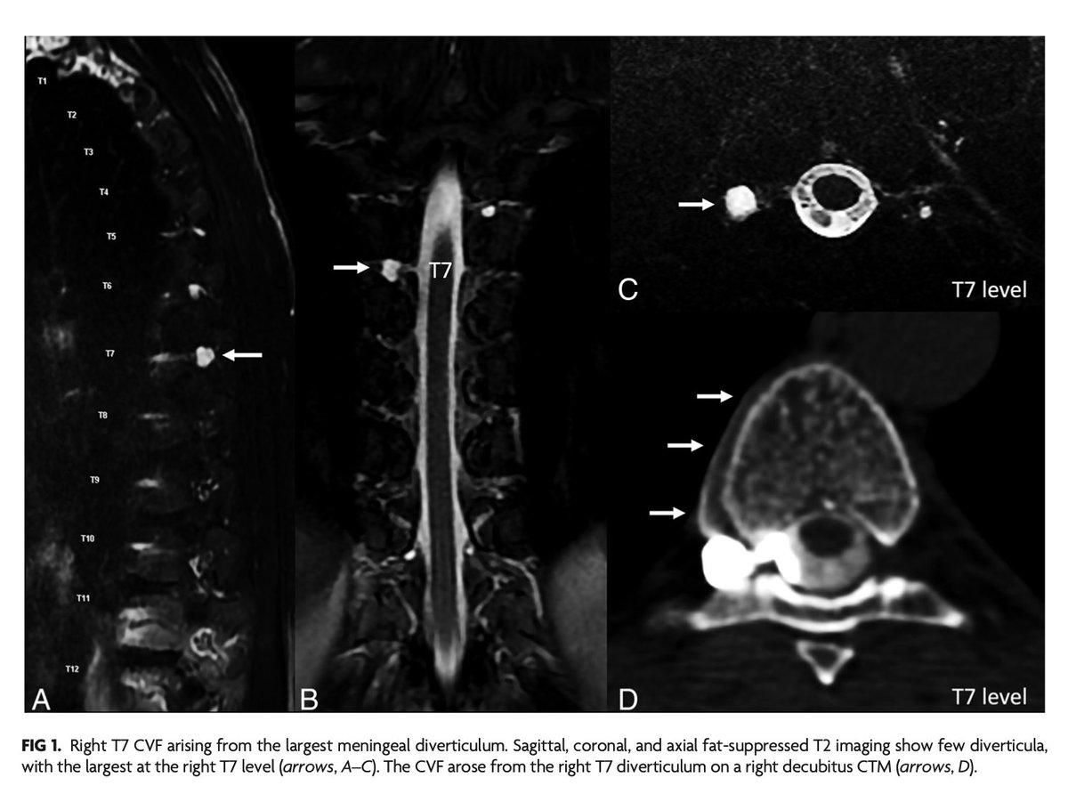TheAJNR's tweet photo. "Spine MRI Diverticular Patterns Predict CSF-Venous Fistula Location: A 100-Patient Study"

https://t.co/rilQq7wwjF

@MarkMamloukMD https://t.co/V2gqrXXAnv