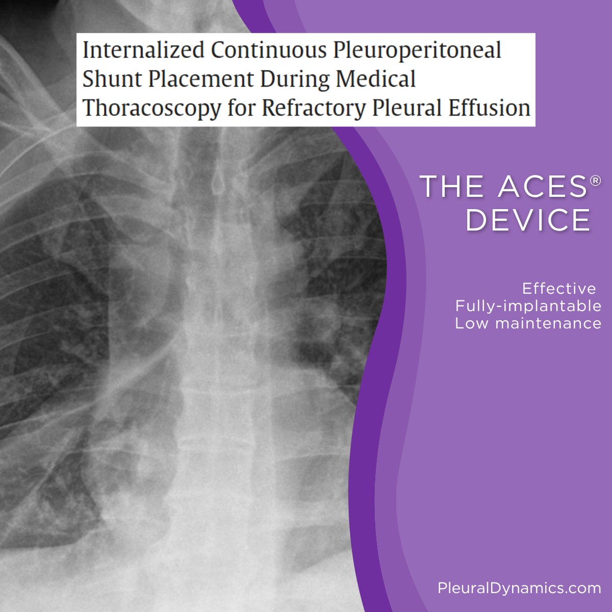 pleuraldynamics's tweet photo. What happens when pleural effusion management is reimagined?🫁A new published case highlights the ACES® device in a patient with recurrent pleural effusion.

A fully implantable approach aimed at reducing patient burden &amp; eliminating the need for ongoing drainage &amp; management. https://t.co/X90voCYAXH