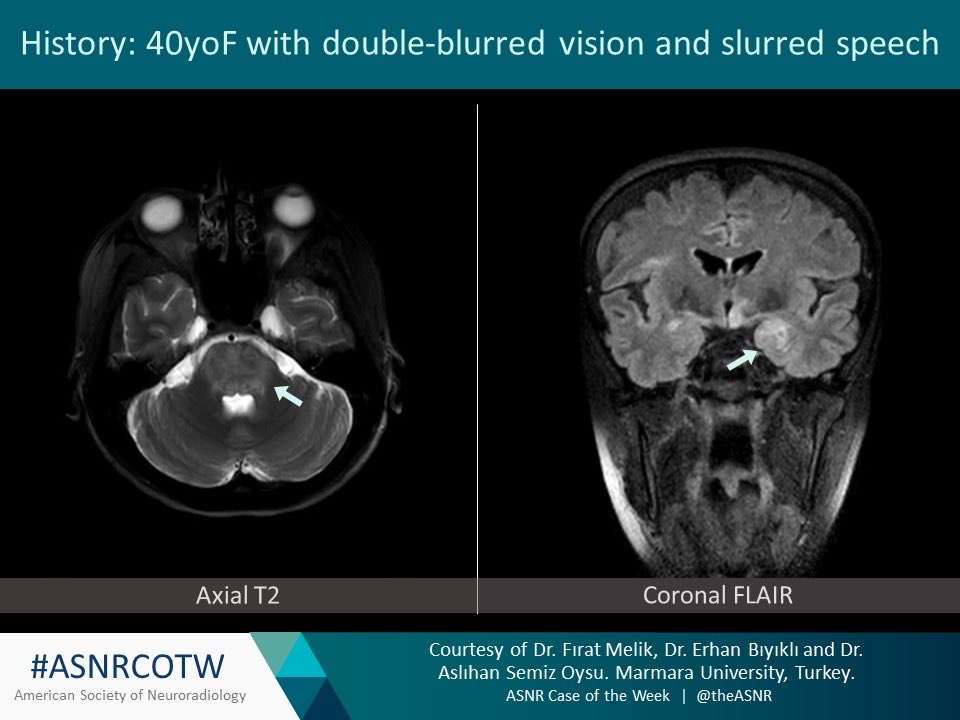TheASNR's tweet photo. ASNR COTW # 297

Hx: 40yoF with double-blurred vision and slurred speech

NO SPOILERS! Give hints in the form of GIFs or answer poll. Answer in 24 hours.  

#neuro #neurorad #radres #FOAMed #FOAMrad #medtwitter #ASNRCOTW https://t.co/C8eQJiUwZZ