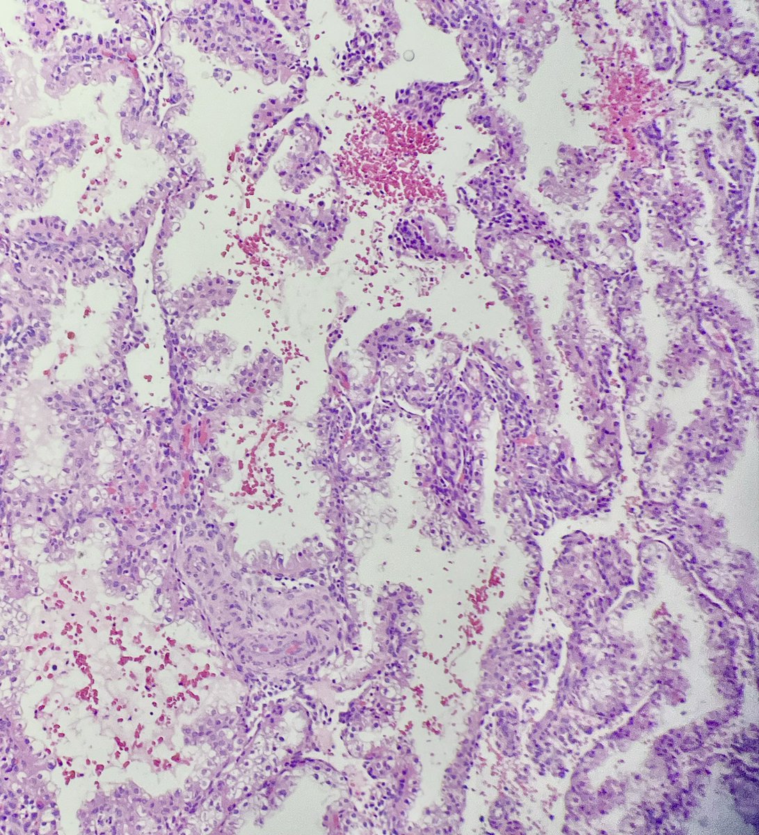 Babker_Path's tweet photo. #Path_resident_teaching_pearl 🧠
: Arias-Stella reaction in endometrial biopsy

🔍 Key histologic clues:
• Marked nuclear enlargement with hyperchromasia
• Vacuolated / clear cytoplasm, sometimes hobnail-like cells
• Preserved overall architecture (no destructive stromal invasion)
• Low mitotic activity despite striking atypia
• Background of gestational or high progesterone state

⚠️ Common pitfalls:
• Overcalling as clear cell carcinoma or serous neoplasia
• Misinterpretation in ectopic pregnancy or early intrauterine pregnancy
• Focusing on nuclear pleomorphism without considering clinical context

🧩 Pearl: “Atypia out of proportion to behavior”, always correlate with pregnancy history and hormone status.

#Pathology #GYNPath #PathX #pathtwitter #DiagnosticPitfalls