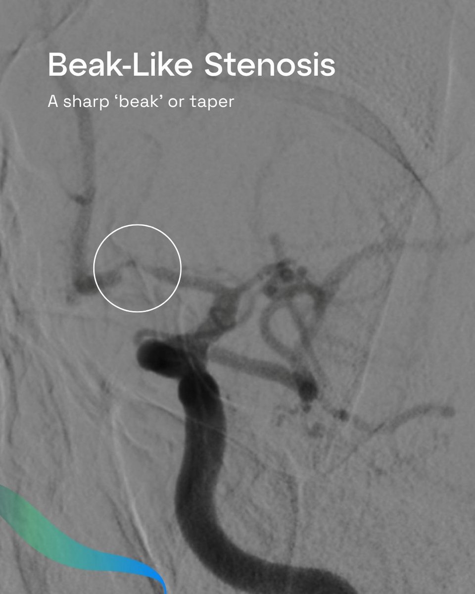 GravityMedTech's tweet photo. Spot the difference: Intracranial Atherosclerosis vs Embolus causing large vessel occlusion stroke

Dr. Keiko Fukuda highlights the key clues in supporting a diagnosis.

#GravityConnect #Neurovascular #ICAD #StrokeCare https://t.co/nCNMzEecj8