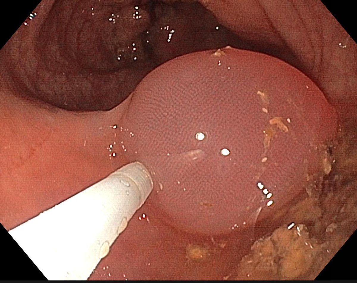 GavricAle's tweet photo. What can go wrong when tattooing the colon?

I was always focused on not injecting it too aggressively.

This one seemed neat, but I went too “supra-submucosally,” as a few weeks later during surgery there was no tattoo.

As everywhere: the best path is in the middle. https://t.co/GUfiKif9WJ