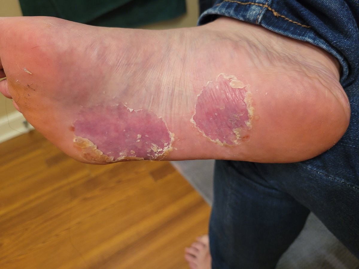 elodubz's tweet photo. @elijahliststeve 32 years of no issues with my immune system and 2 days after the second shot the symptoms started. Eventually both feet were covered in pustules that would leak clear fluid and the top skin layers were gone. Took over two years for those layers to grow back. Still dealing with it https://t.co/YM5nqP7DqM