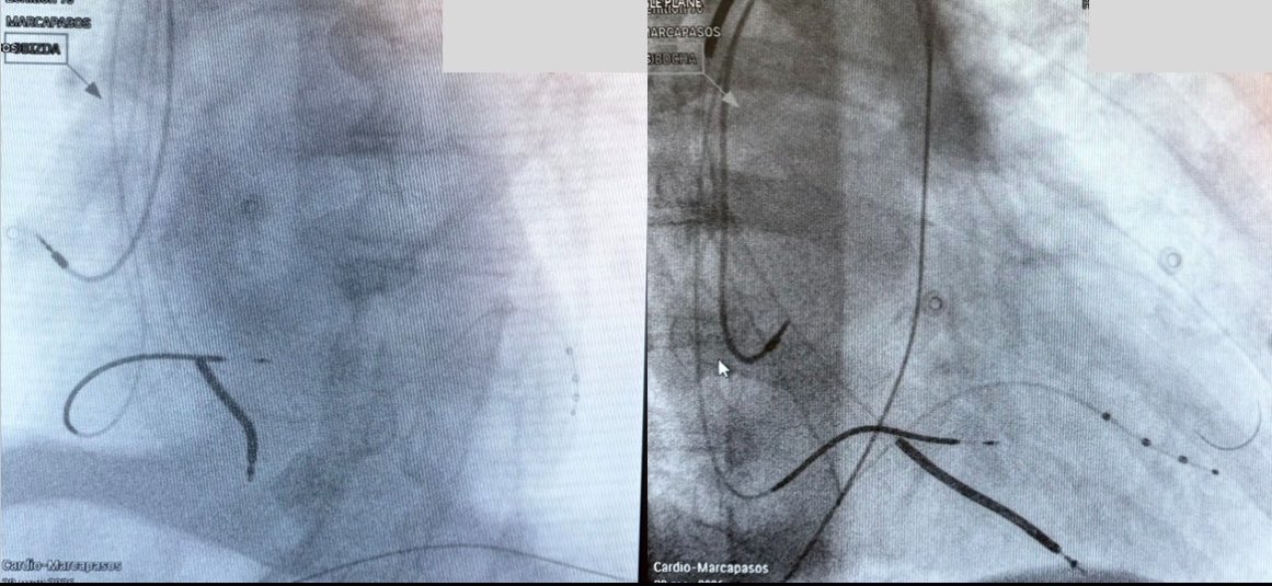 odbobin's tweet photo. 81 yo p, ischemic cardiomyopathy. ICD primary prevention(2009); LBBB, HF: upgrade to CRT(2017). Generator reached ERI and the defibrillation lead showed signs of fracture. We decided to implant small diameter #OmniaSecure™ lead+replacement of the ICD generator, providing LOT-CRT https://t.co/NqYI8sgOCg
