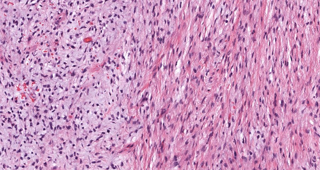 JMGardnerMD's tweet photo. Deep thigh mass. Can you make diagnosis from one pic, or #TooCloseToDiagnose? 
Answer ✅ https://t.co/IfEvVaUEsD 
If you could only get ONE immunostain, what would it be?👉https://t.co/io7WsRFKdA
#pathology #pathologists #pathTwitter #dermpath #dermatology #dermtwitter #BSTpath https://t.co/qiAIUdF9VE