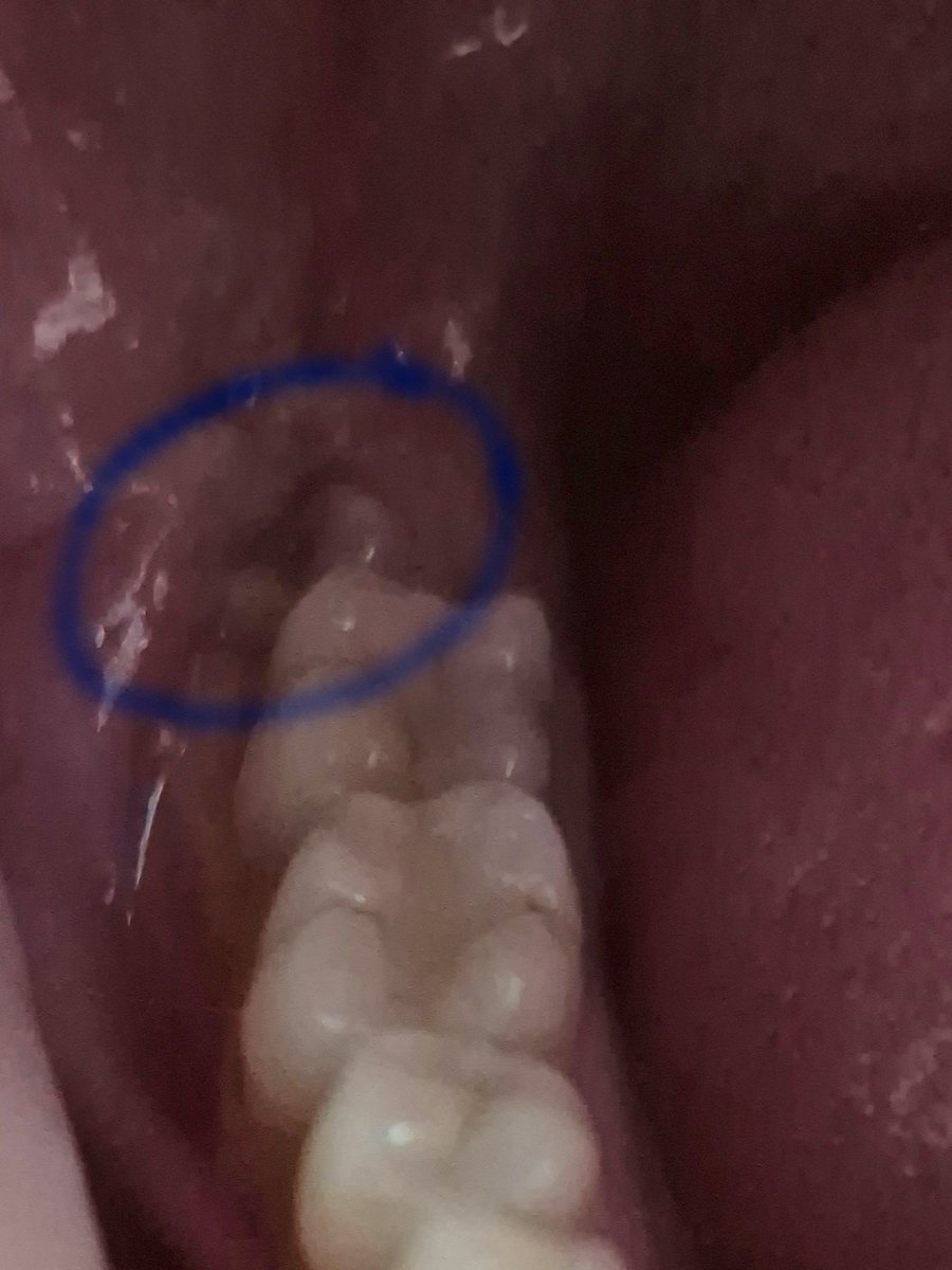 LilithLowe's tweet photo. Hi @NHSEngland @NHSuk 
I really need this wisdom tooth removed and have done for 6 years now but no one seems to be willing to remove it, private or nhs. Nor will they tell me whether they've done a referral or not to have it done in hospital. Help please? I'm in constant pain https://t.co/EOTRCzLKsz