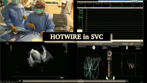 EPLive2's tweet photo. Dr. Devi Nair @Drdevignair takes the stage at #EPLive2026 to present the PERSIGMA RCT! 📊📷 This randomized controlled trial directly compares the safety and effectiveness of the VARIPULSE™ PFA catheter against the FARAWAVE™ PFA catheter for persistent AF patients. #EPLive #EPeeps #AFib #ablation #EPLive2026 #EPLiveAustin2026 #VARIPULSE #PERSIGMA #PFA