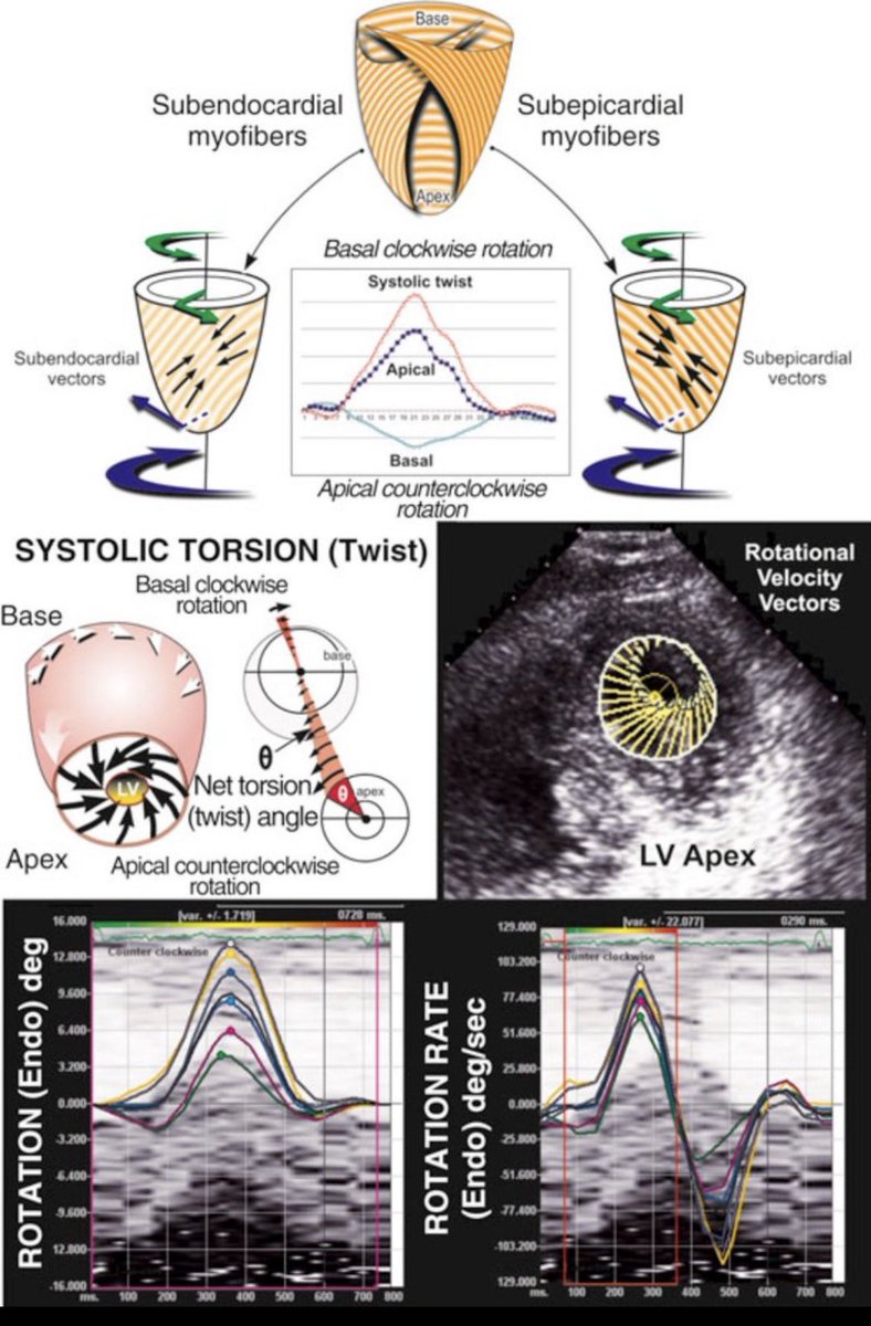 LV torsion reflects the heart’s twisting motion during systole, with ...