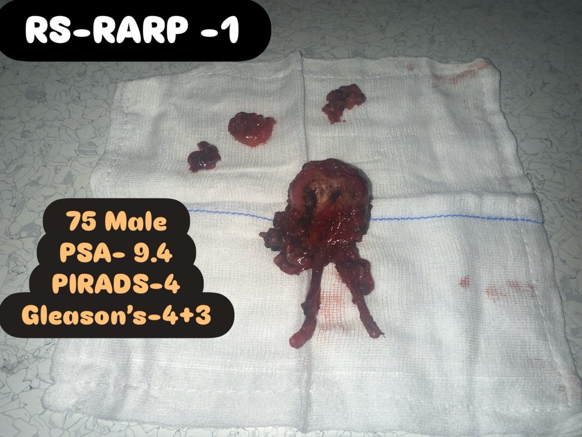 DrDeepakJK's tweet photo. 4 Robotic Radical Prostatectomies for Prostate Cancer in 1 month Feb 2026 😎🙏

All margins negative
All almost completely continent &amp;
PSA Normal at 3 months
😎👌 All With Retzius Sparing RARP!👌🙏

From 6 RARP in 2 years 
to 4 prostatectomies in 1 month!
What a transformation!☺️ https://t.co/FZ51nFcxeW