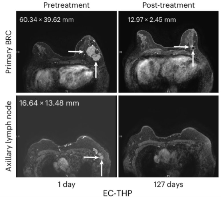 stemcellpodcast's tweet photo. In this @NatureCellBio study, researchers have developed a microwell platform that enables rapid enrichment of breast cancer stem cells for personalized drug testing. 💊 

Read more: https://t.co/MmjUTKhcV5
Listen to the discussion: https://t.co/PN0HT7g6B1 https://t.co/l3pyr7jiaE