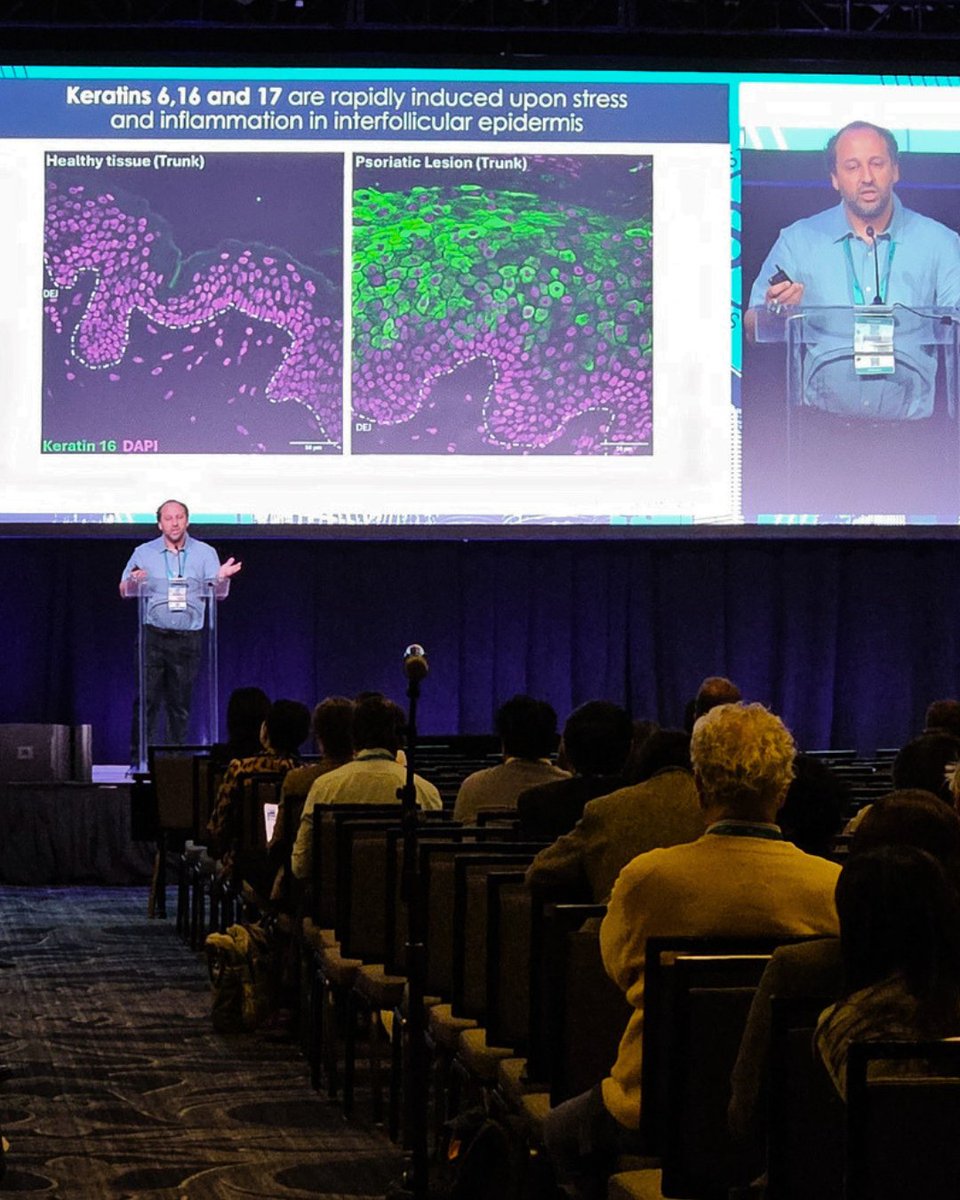 Pachyonychia's tweet photo. We were excited to listen to Erez Cohen, a post-doctoral fellow, give his presentation, “Keratin 16 spatially inhibits type 1 interferon responses in stressed and diseased skin” on the big stage at the Society for Investigative Dermatology Meeting. This ground-breaking work, done in Professor Pierre Coulombe’s lab, is leading to new avenues to explore for PC treatment options. Thanks to all who donate to PC Project so we can fund this cutting-edge research!

#EndThePain #RareDisease #PPKs #pEDDs #pachyonychia