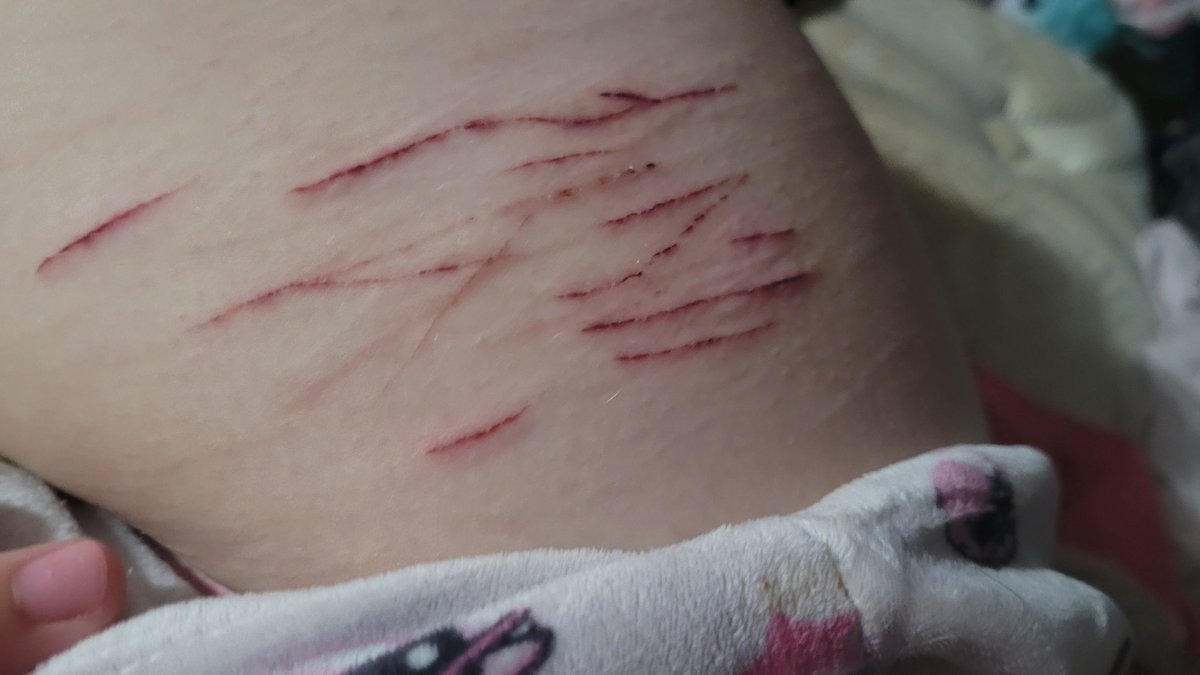CeCe_wL's tweet photo. Enjoy my really shitty cuts from a dull knife cause my bf pissed me off https://t.co/aTRKGOc0sR