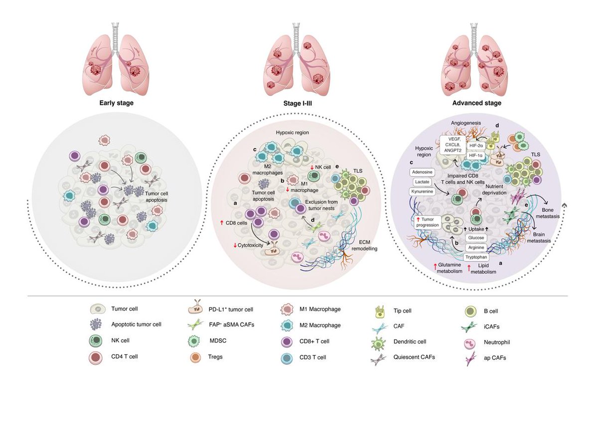 Savai_Lab's tweet photo. 🚨New paper alert: Lung cancer is more than just tumor cells. Our new review highlights how the TME changes over time, causing resistance and influencing therapy response-an important step toward more effective treatment strategies🫁🔬 https://t.co/kp75SNTSXV @selma_diz @r_savai https://t.co/vcNZpH1ahJ