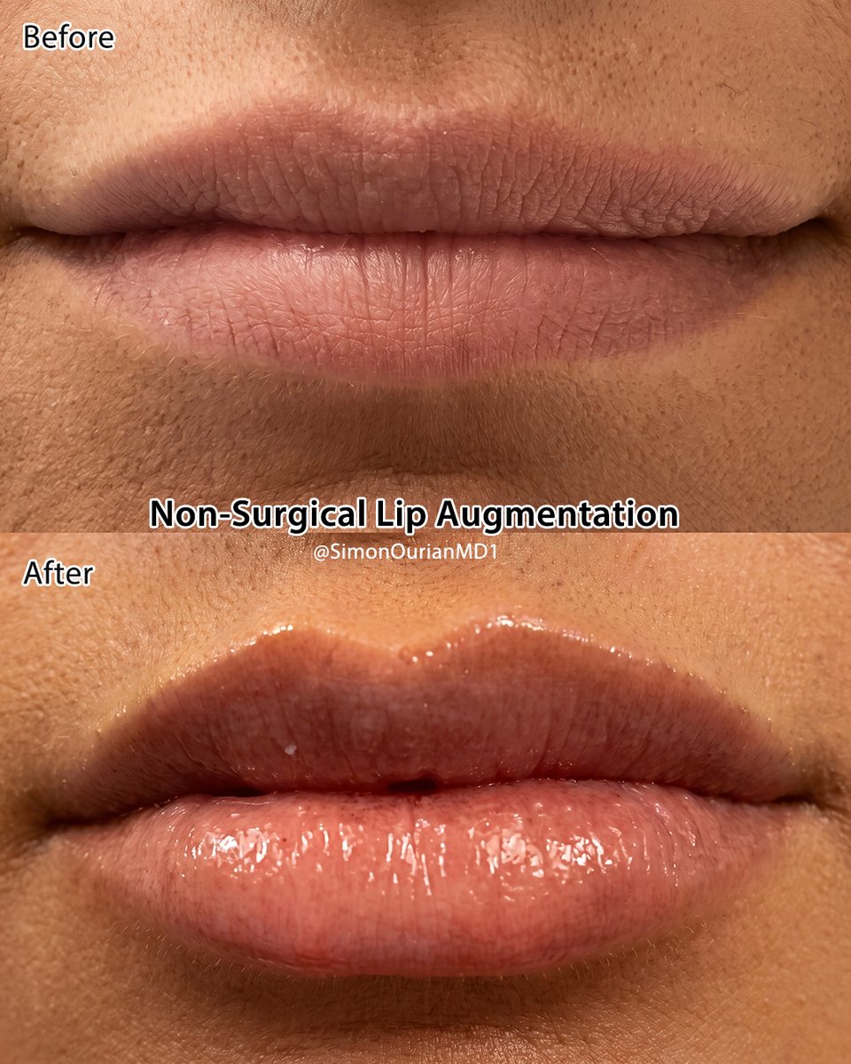 simonourianmd's tweet photo. Non-surgical lip augmentation improves lip shape, defines the lip border, and adds soft, natural-looking volume for fuller, more balanced lips—without surgery.

Using Neustem™ injections, this treatment adds soft, natural-looking volume, improves lip symmetry, smooths lip lines, and enhances lip contour for fuller, more balanced lips.

#lipaugmentation #lipfillers #naturallips #lipenhancement #dermalfillers