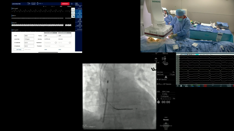 EPLive2's tweet photo. 🔴 LIVE |  implanting LBB pacing with the Medtronic 3930 lead at #EPLive2026. Conduction system pacing: restoring synchronous, physiological LV activation. Is LBBArea pacing replacing BiV CRT in your practice? ⚡🫀 #LBBPacing #CSP #PhysiologicalPacing #EPeeps https://t.co/ZGiX0VwwuN