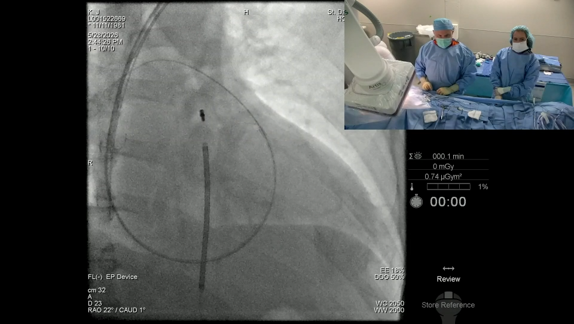 EPLive2's tweet photo. 🔴 LIVE |  implanting LBB pacing with the Medtronic 3930 lead at #EPLive2026. Conduction system pacing: restoring synchronous, physiological LV activation. Is LBBArea pacing replacing BiV CRT in your practice? ⚡🫀 #LBBPacing #CSP #PhysiologicalPacing #EPeeps https://t.co/ZGiX0VwwuN