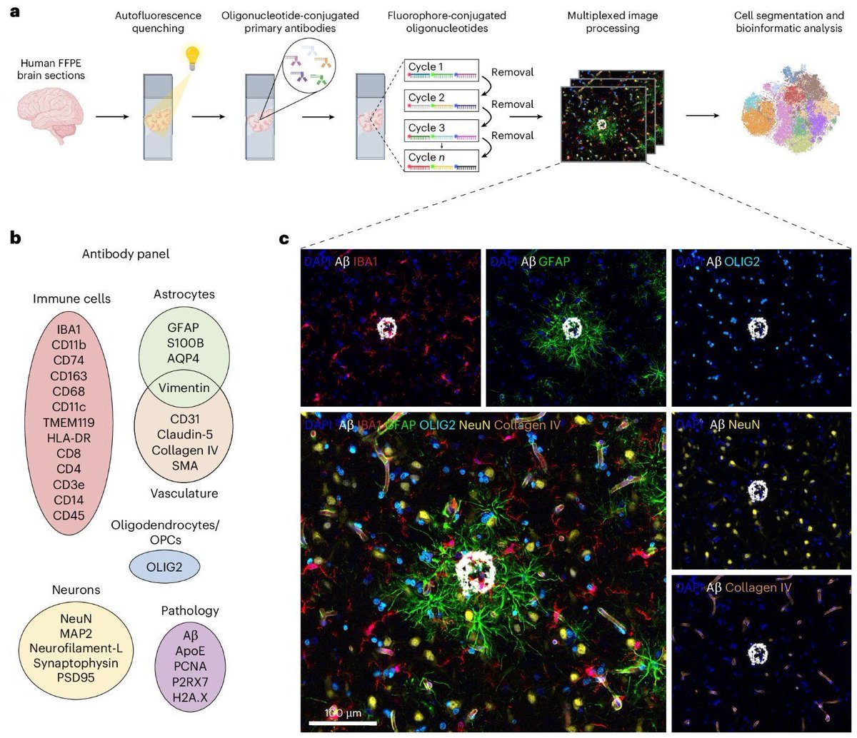 jonlieffmd's tweet photo. Alzheimer's patients, the researchers made a crucial discovery: a specific group of disease-associated immune cells (known as microglia) that accumulate specifically in a particular form of typical protein deposits (amyloid-β plaques) https://t.co/h2ix6gwj5M https://t.co/mFYy4Aysi0