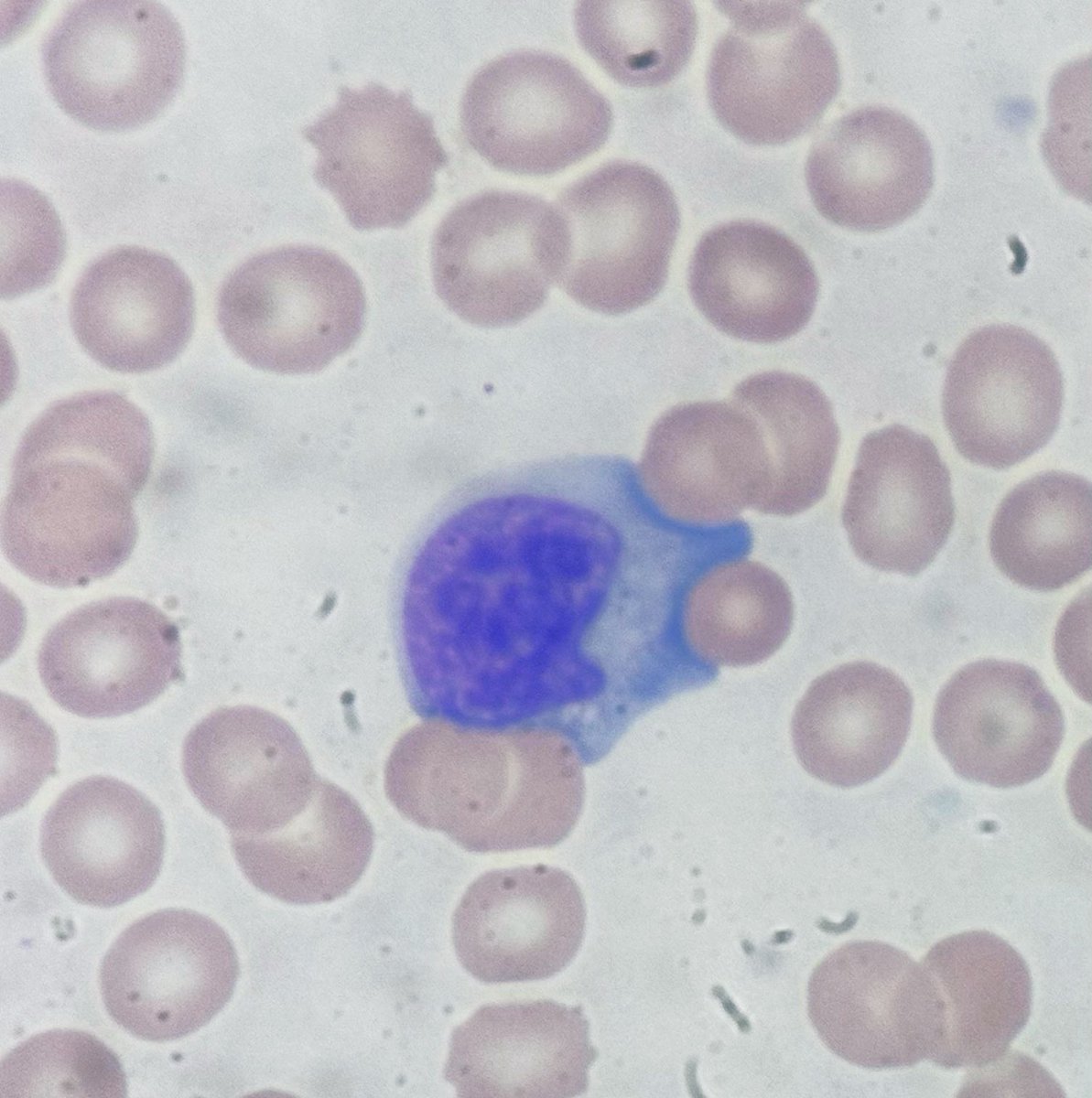 PathologyKate's tweet photo. They called me because they thought the patient had malaria, but actually he has……?? https://t.co/mpdlcvhlU0