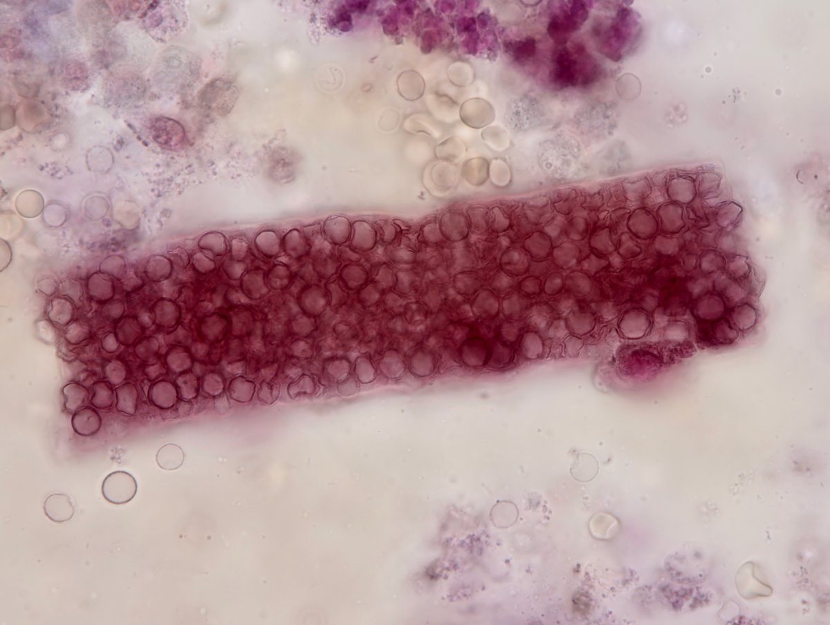 jrseltzer's tweet photo. RBC cast - brightfield and oblique/darkfield, with SM stain - from patient with AKI in the setting of MSSA MV endocarditis and vertebral osteomyelitis - #UrinarySediment #UrineMicroscopy https://t.co/FTSLyPXste