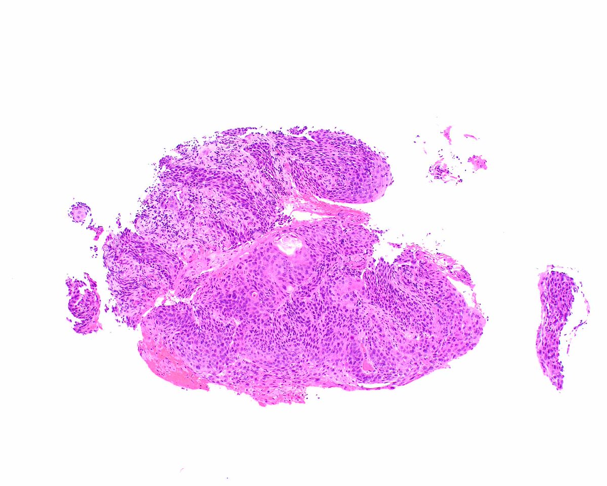 ModernPathology's tweet photo. There is a lot happening with squamous cell carcinoma.  This esophageal example has a null p53 expression pattern.  Check out this new article!
Zhang AW, et al PMID: 40902853. https://t.co/r9RR4Ymwck