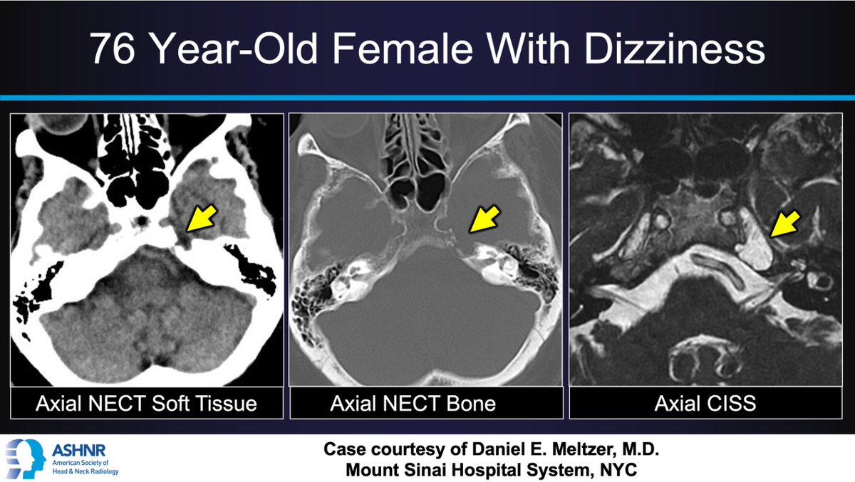 ASHNRSociety's tweet photo. #ASHNRCOTW 342: ANSWER.  Thx Dr. Meltzer 4 case! #ASHNR26                   

@callyrobs @DShatzkes @CDP_Rad @rhwiggins @nakoontz @KRileyMD @CMGlastonbury @tabby_kennedy @PhilipRChapman1 @cmtomblinson
@amyfjuliano @bpoliceni @MohitTCCNeuro @AshokSrini15 @KatieTraylorDO @CynXinWu https://t.co/GmEWj0d30k