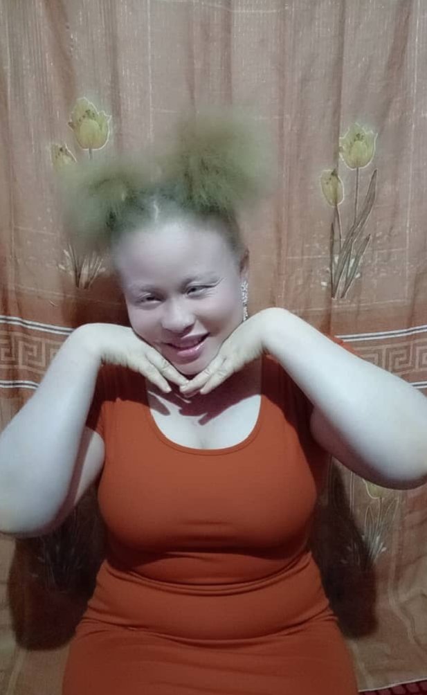 Shiny Sisters(Albinism is beautiful)😍 tweet media