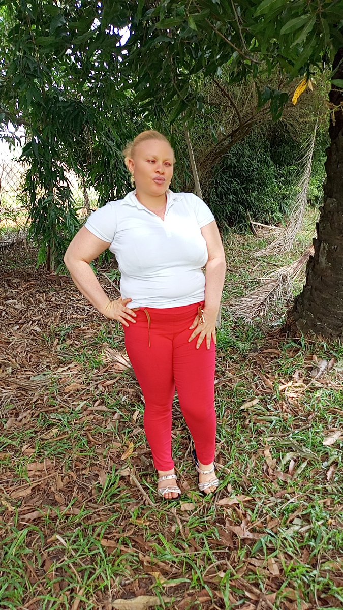 Shiny Sisters(Albinism is beautiful)😍 tweet media