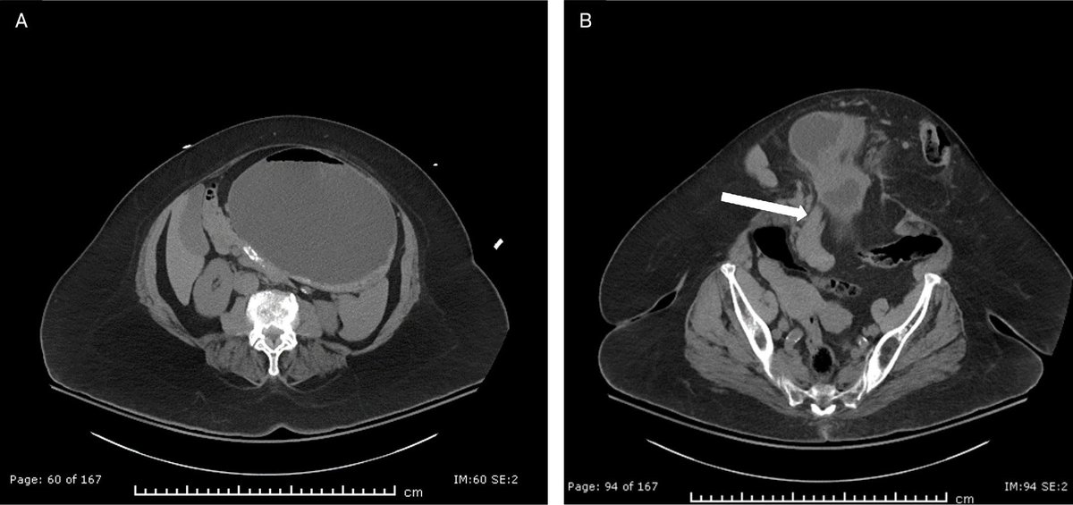 Applied_Rad's tweet photo. Case Review: Stomach-Containing Paraumbilical Hernia with Obstruction
Gastric herniation into an existing paraumbilical/umbilical hernia is a rare complication.
π Do you know what to look for? https://t.co/zssCAZ4u8H
#Radiology #RadEd #MedEd #RadiologyEducation #GIimaging #CaseReview