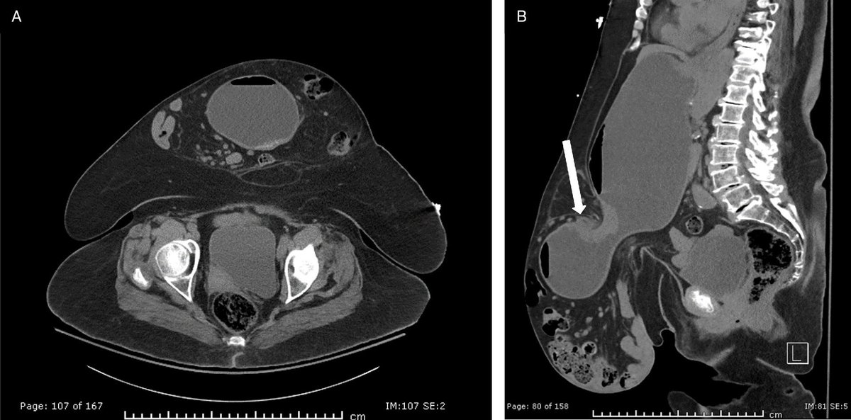 Applied_Rad's tweet photo. Case Review: Stomach-Containing Paraumbilical Hernia with Obstruction
Gastric herniation into an existing paraumbilical/umbilical hernia is a rare complication.
π Do you know what to look for? https://t.co/zssCAZ4u8H
#Radiology #RadEd #MedEd #RadiologyEducation #GIimaging #CaseReview