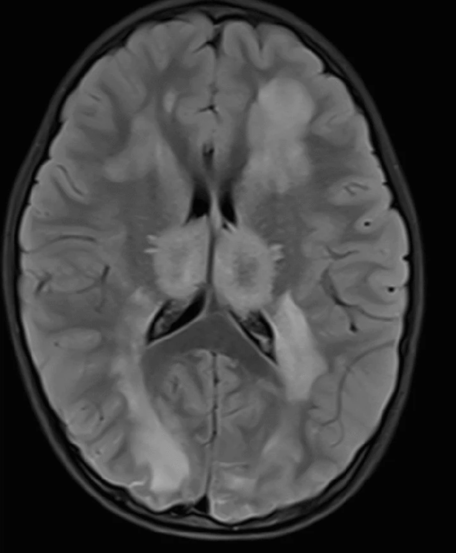 neurochecklists's tweet photo. This is acute necrotizing encephalopathy https://t.co/jKLHdeODG5 https://t.co/XEm5KAHunr