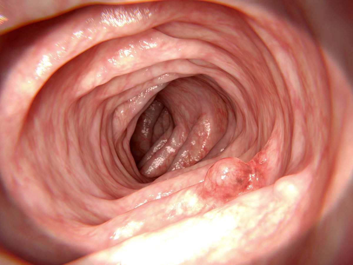 NewsMedical's tweet photo. ⚡️ Years after polyp removal, women’s gut microbes still show patterns linked to colorectal cancer - suggesting hidden risks may persist long-term.  https://t.co/wjWf0LRFWj #ColorectalCancer #GutHealth #Microbiome 🧬 @cellhostmicrobe https://t.co/azhEstyEC4