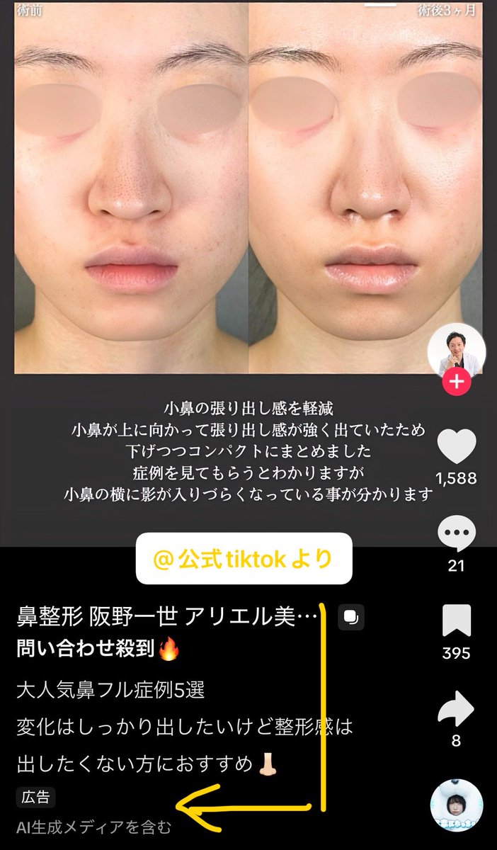 鼻整形の良医選び🏥鼻尖形成、鼻中隔延長、鼻フル、プロテーゼ、鼻翼縮小、小鼻縮小、貴族手術、人中短縮 tweet media