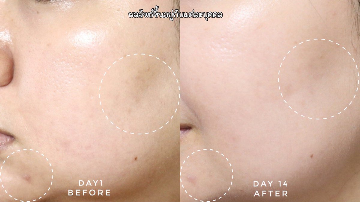 yingpeereview's tweet photo. ผิวละเอียดขึ้น ฝ้าแดดจางลงตั้งแต่ใช้คู่นี้ทุกวันเช้าเย็น  Eucerin Spotless Brightening ที่มีไทอามิดอล สารไบรท์เทนนิ่งที่เก่งสุดละในตลาดตอนนี้ หมอผิวหนังก็แนะนำให้ใช้ เริ่มลงน้ำตบก่อนผิวใสฉ่ำมากก ตามด้วยตัวบูสเตอร์เซรั่มนี่ตัวเอกเรื่องลดฝ้าเลย นี่เคยใช้เซรั่มมาขวดนึงแล้วนะก็ว่าลดฝ้าเริ่ดแล้วนะ ยิ่งตรงบริเวณร่องแก้มอ่ะที่ฝ้าชัดๆ โบกคู่นี้มา 3 วันมันก็จางลง ทำถึงเกิน ใช้คู่กันฝ้าแดดจากลงไว ผิวใสสุดๆคือ แล้วผิวเนียนทั้งหน้าเลย ไอเลิ้ป