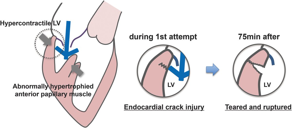 ESC_Journals's tweet photo. Beware of rare delayed LV rupture post M-TEER esp in elderly with limited space near commisure lesions https://t.co/VeYKgHwzXh

#EHJCaseReports @Phiso_de @TJ_Yeo @aayshacader @girishviswa @SukritiBanthiya  @O_Azizy_MD @saramoscatelli7 @EHJCREiC #CardioX https://t.co/BcDkHMaL4D