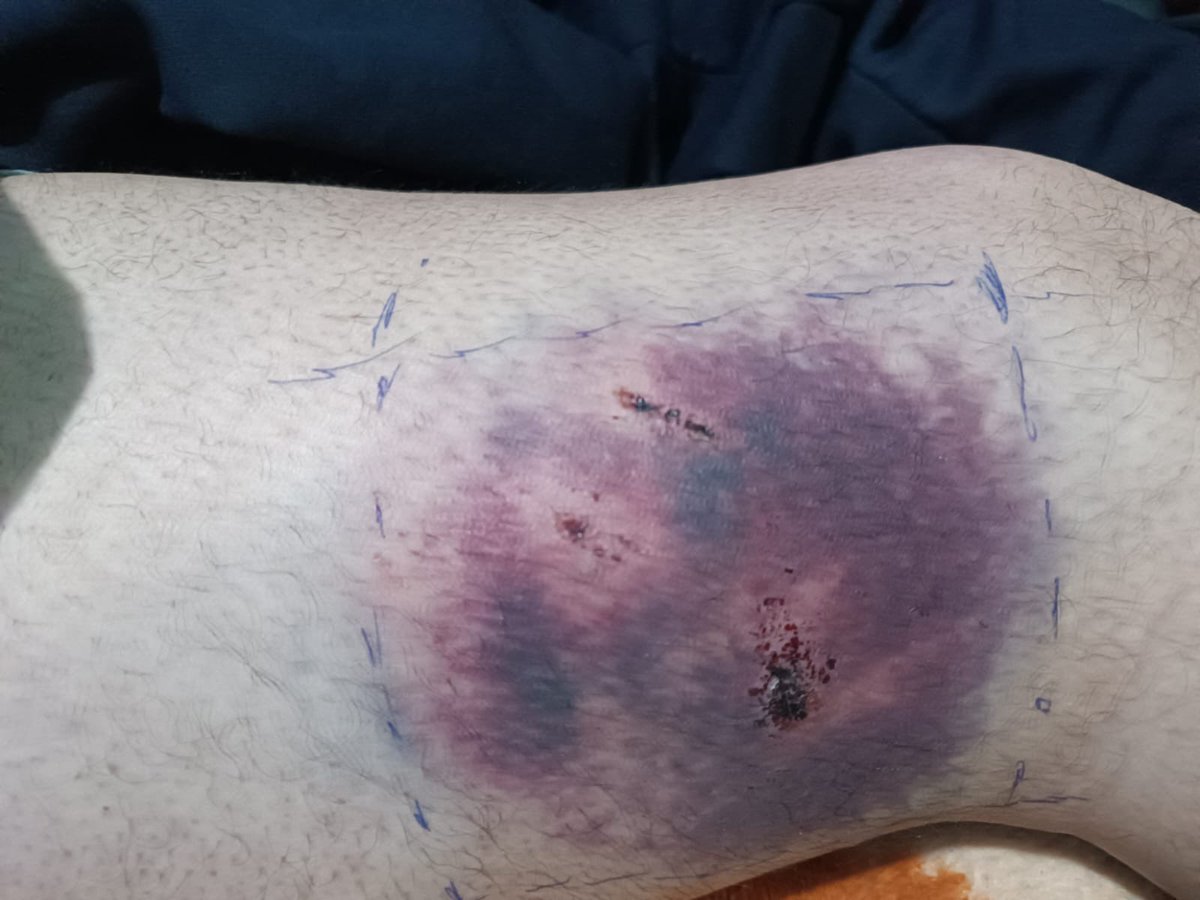 Duguso1983's tweet photo. Tu ayuda sería muy útil para mi recaudación de fondos en GoFundMe. Comparte, apoya o dona. Cada pequeña acción cuenta. https://t.co/GK8vwKkGZS https://t.co/aJcmE1wSGG