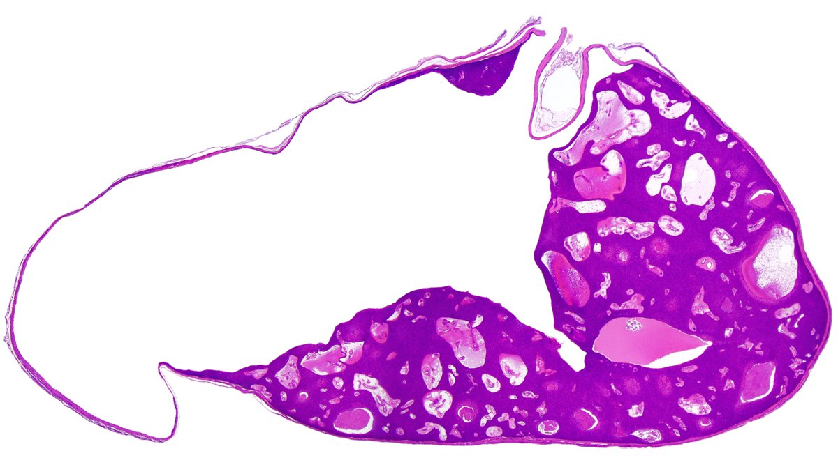 Patholwalker's tweet photo. Poroid hidradenoma. #Pathology #Pathologist #DermPath https://t.co/2ldfFl4nkC