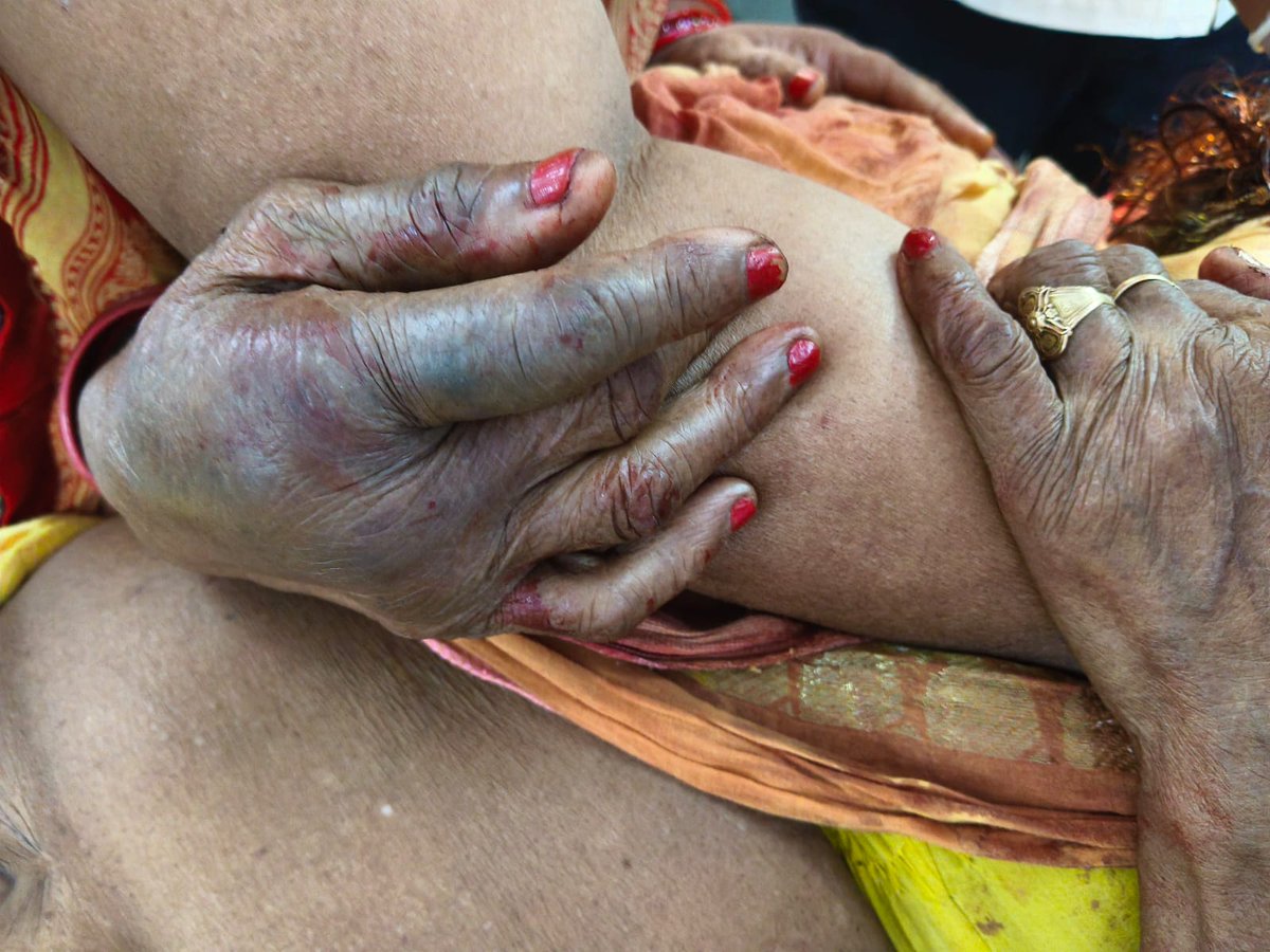 pdst_2007's tweet photo. #uppolice #yogiji #bjp #police
My Mother has been attacked by a lady named Vandana Santosh Tiwari she is one of my neighbors. When she went for a walk that time attacked her to kill and tried to snatch her gold. With the god grace she was able to survive. https://t.co/KxntIoWadG