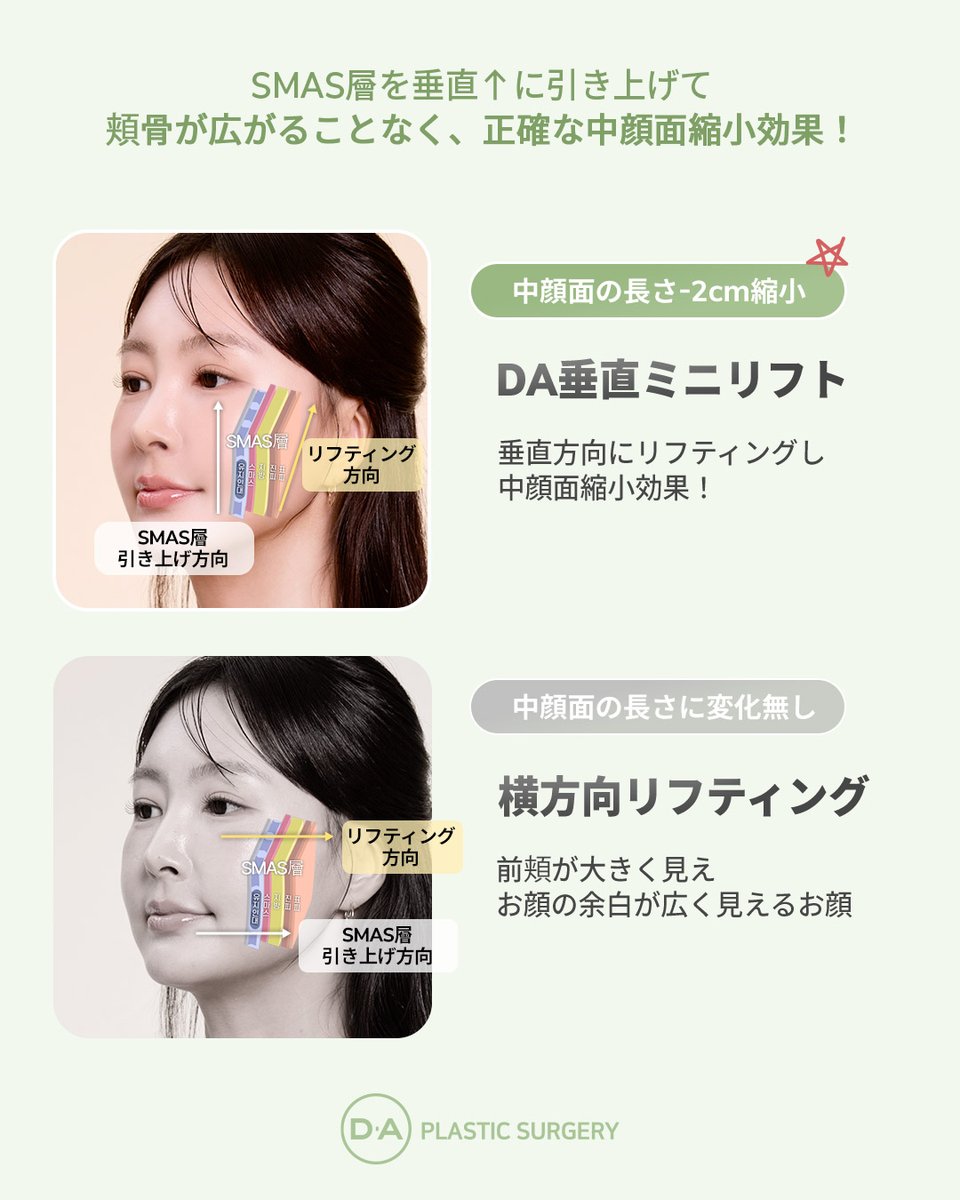 daprsjp's tweet photo. 🌸【綺麗になりたいなら？DA美容外科】🌸

DA #輪郭整形
✨✨✨#3D小顔輪郭術✨✨✨

​立体感重視
Eライン角度重視
グラデーション再配置

お問い合わせください😘

🔽公式ライン🔽➡https://t.co/SM8bYFdhNe https://t.co/Gu7WXccpaF