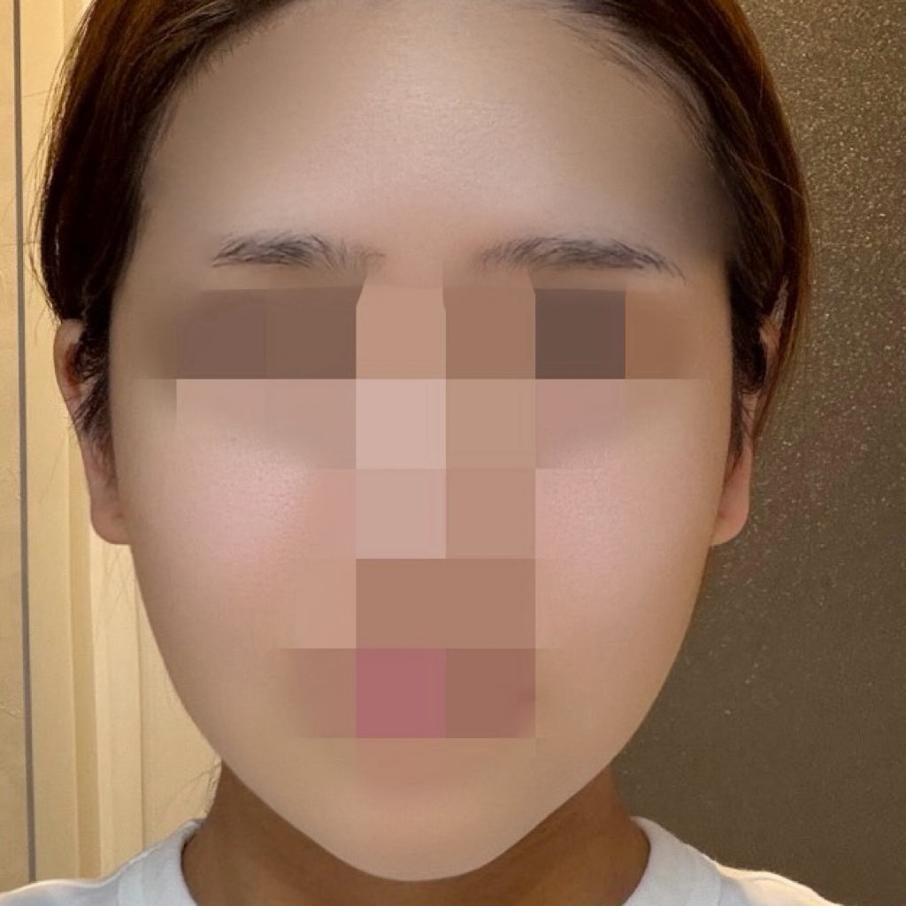 Stjp5qv's tweet photo. 輪郭３点から1ヶ月経過
腫れがだいぶおさまってきて、まだ腫れてるけどその状態でも術前より顔が小さくなったのが分かるから経過楽しみ https://t.co/XDd8qrOkkn