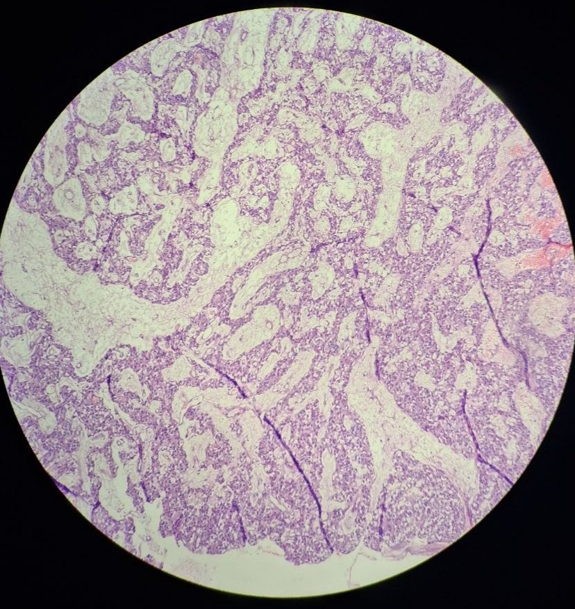 getnet_ghi95154's tweet photo. 40F Thigh dermal based nodule, thoughts? https://t.co/8VGVHTn3D6
